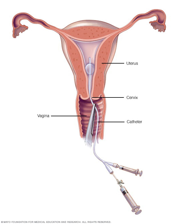 Hysterosalpingographie