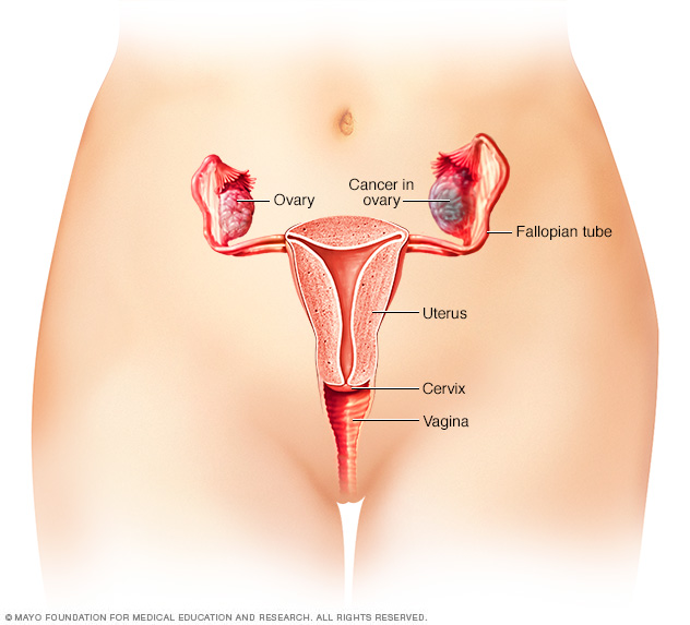 Ovarian Cancer Disease Reference Guide 