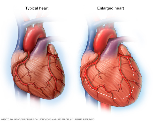 Hypertrophie du coeur
