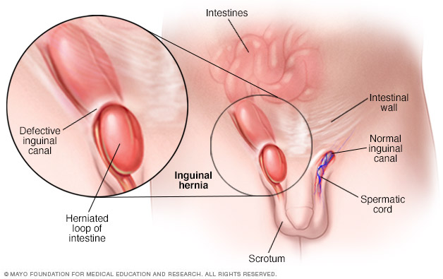 Inguinale hernia: symptomen, diagnose en behandeling Inguinale hernia: symptomen, diagnose en behandeling
