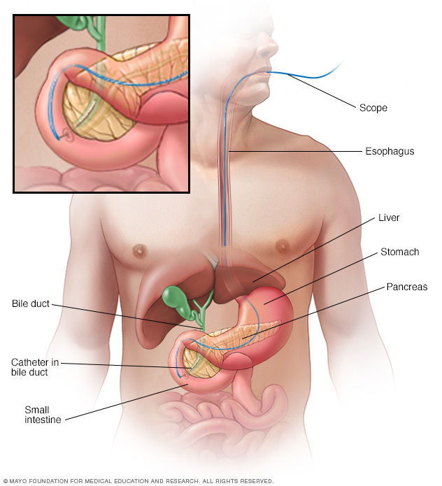 ERCP