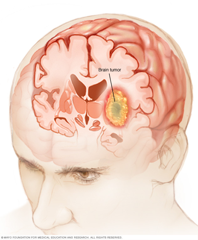 Síntomas y causas del tumor cerebral.