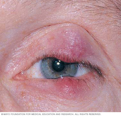 Chalazion