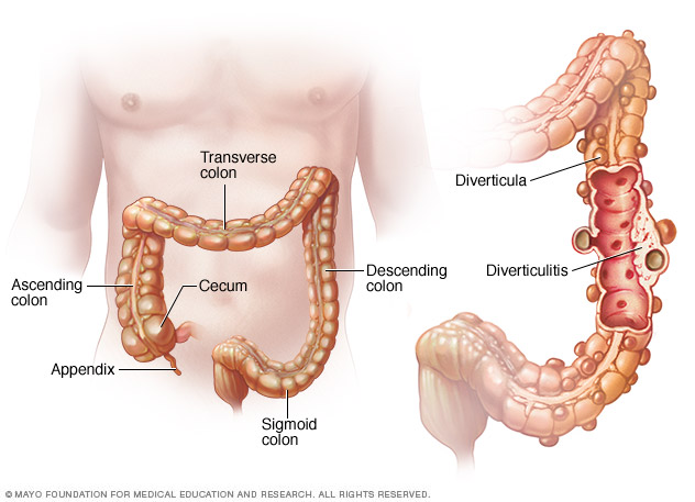 Diverticulitis Disease Reference Guide Drugs