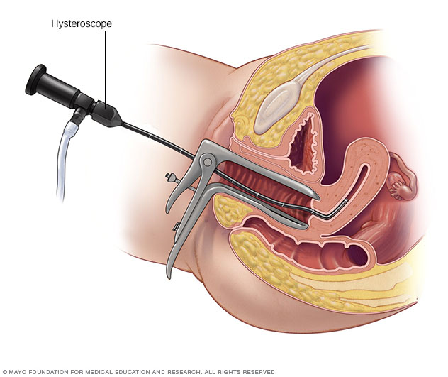 Hysteroskopie