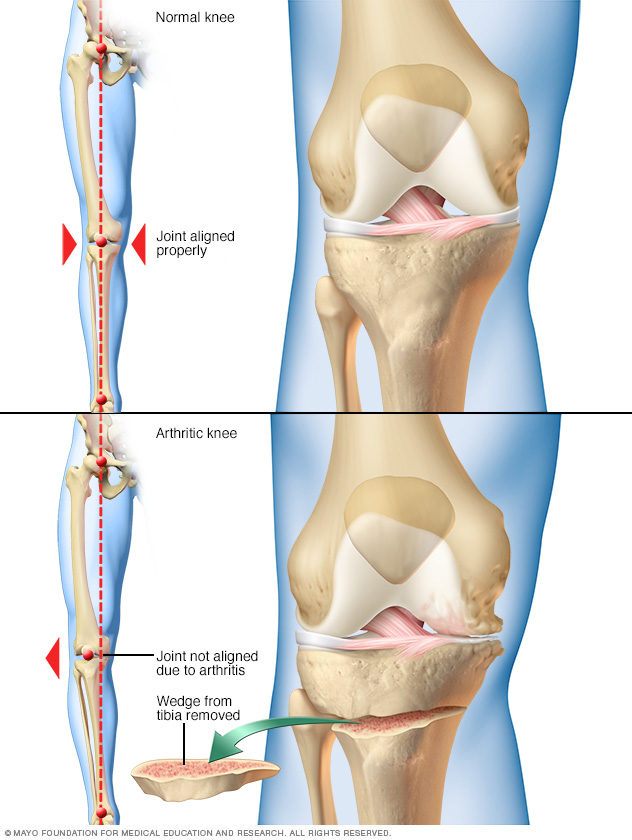Osteotomía de rodilla