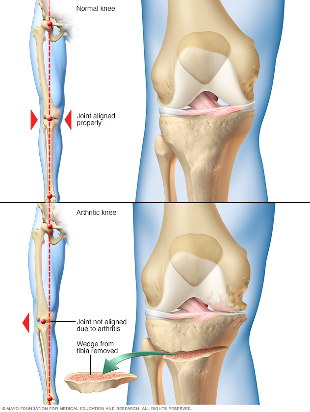 Knä osteotomi