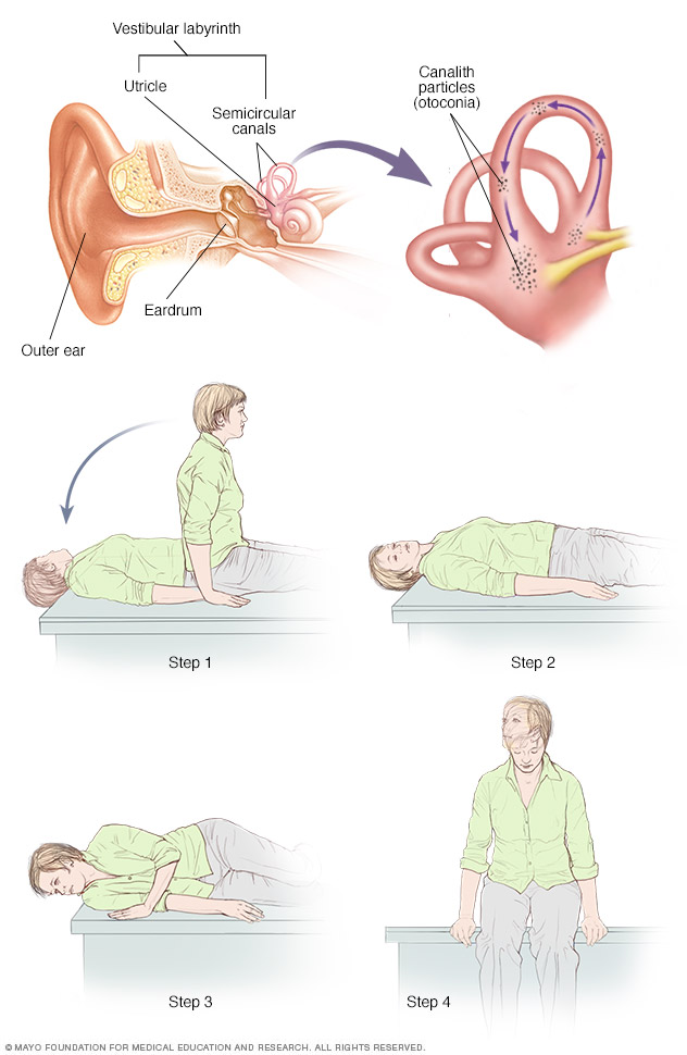 Canalith Repositioning Procedure Drugs
