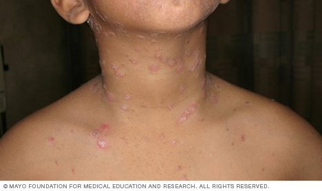 Psoriasis usus