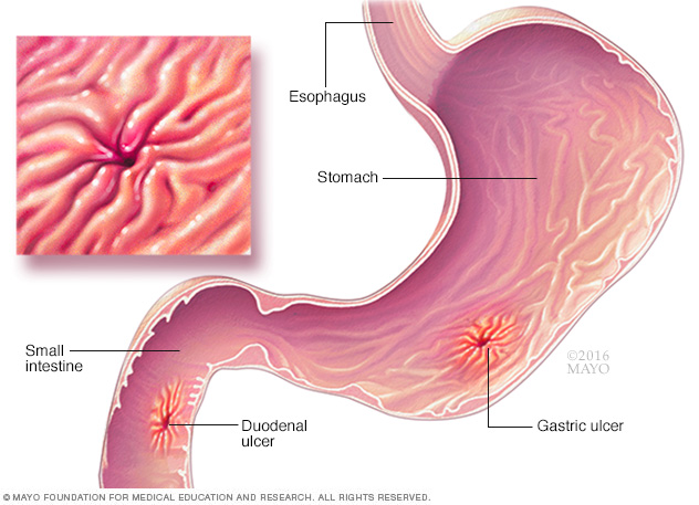 Causas y síntomas de la úlcera péptica