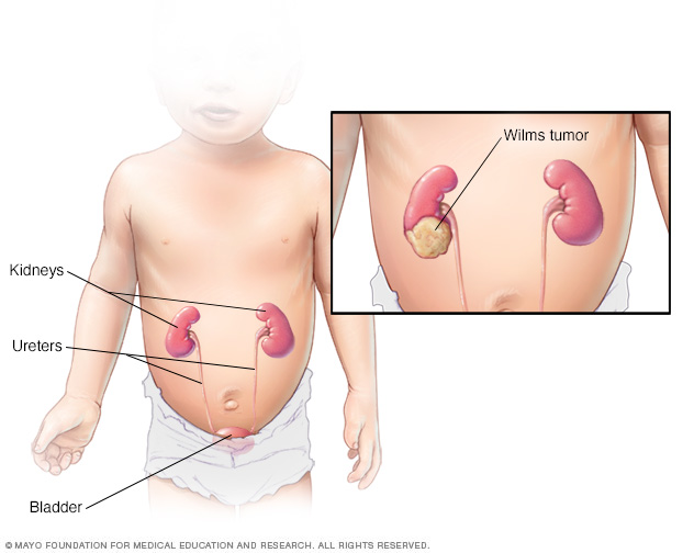 Wilms tumor