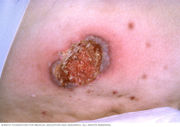 피oderma gangrenosum: 원인, 증상 및 치료 피oderma gangrenosum: 원인, 증상 및 치료