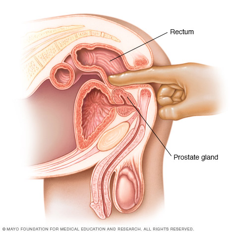 Examen rectal digital (DRE)