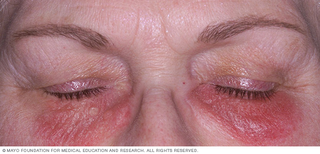 Kontakt dermatitis az arcon
