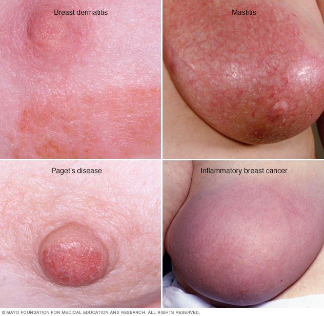 Breast rash 