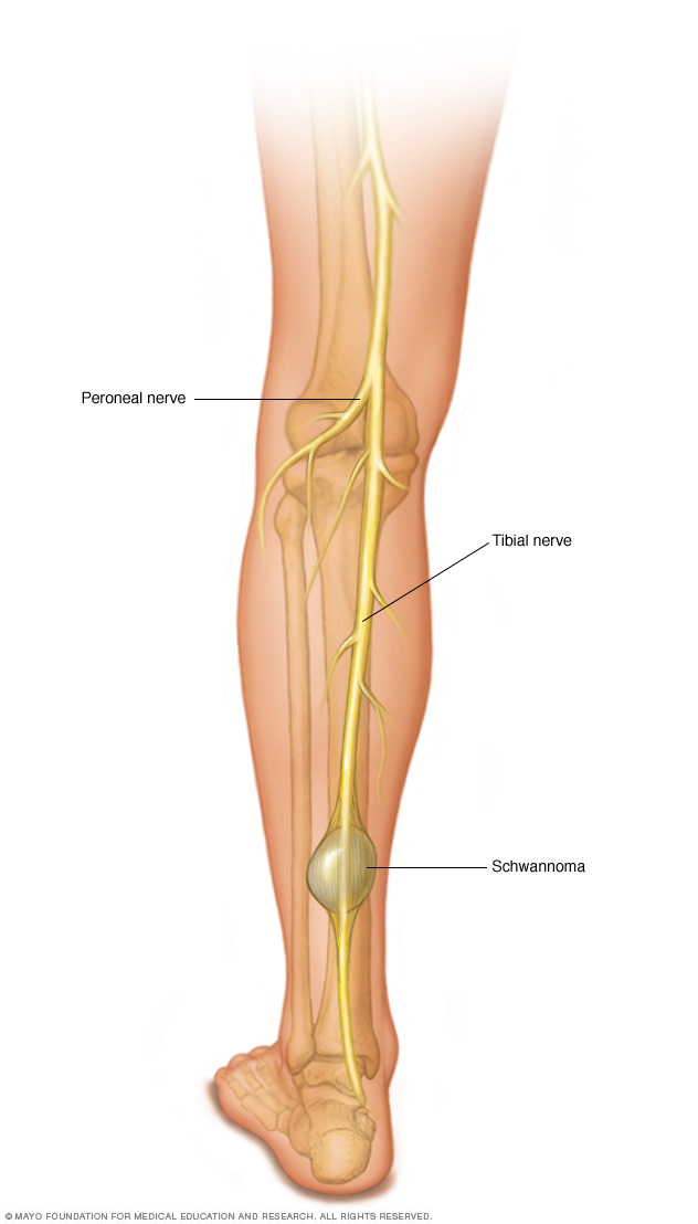 Schwannoma i benet