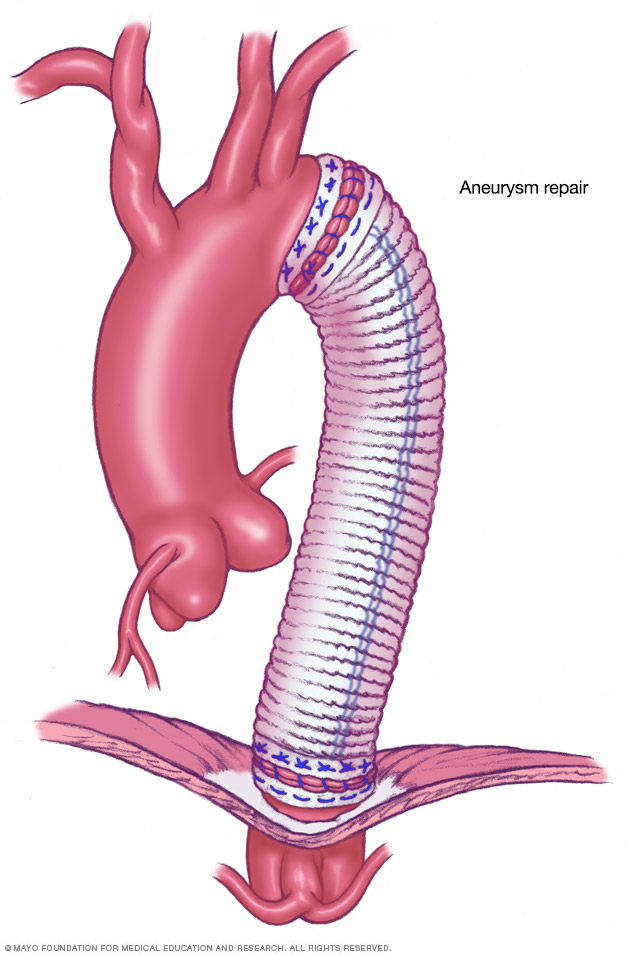 Torasik aort anevrizması için açık göğüs ameliyatı