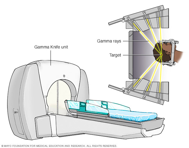 Radiocirugía estereotáctica con bisturí de rayos gamma