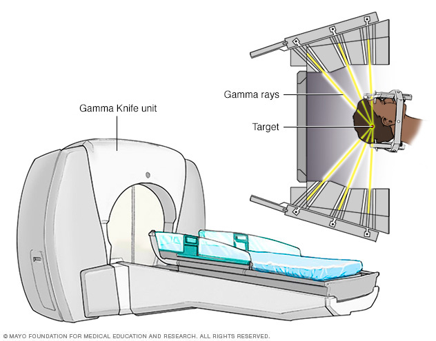 Gamma Knife stereotactische radiochirurgie