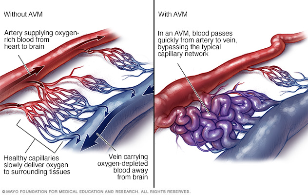 arteriovenöse Malformation