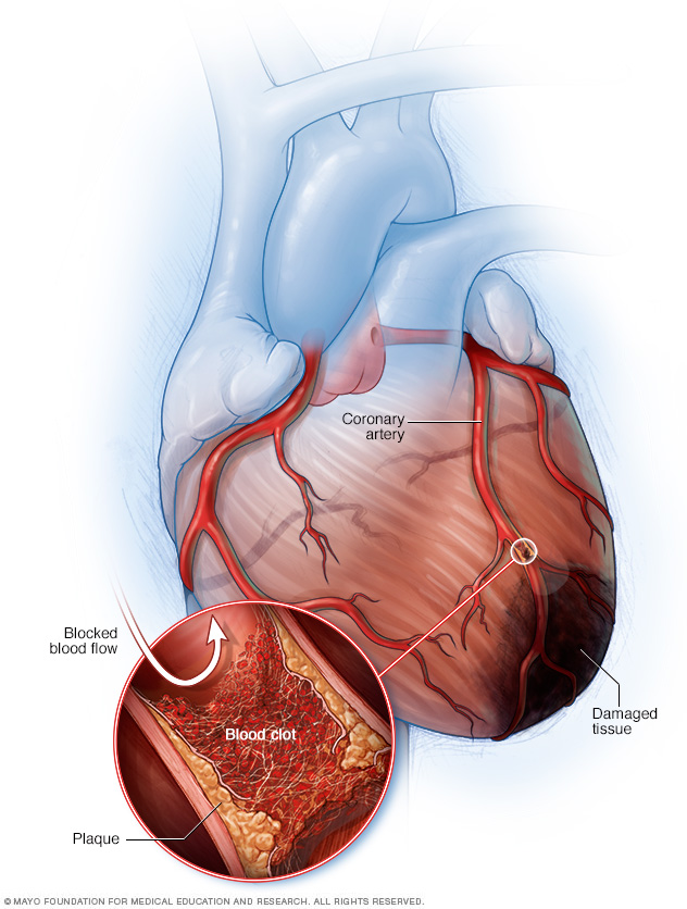 can cryotherapy cause heart attack