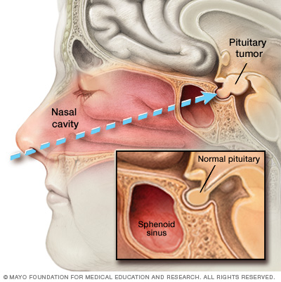 Endoskopisk transnasal transsfenoid kirurgi