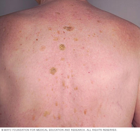 Seborrheic keratoses ที่ด้านหลัง