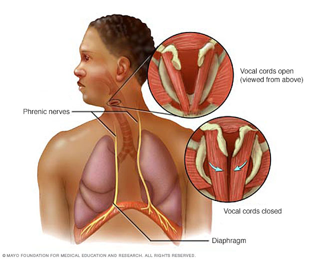 How to get rid of hiccups after anesthesia