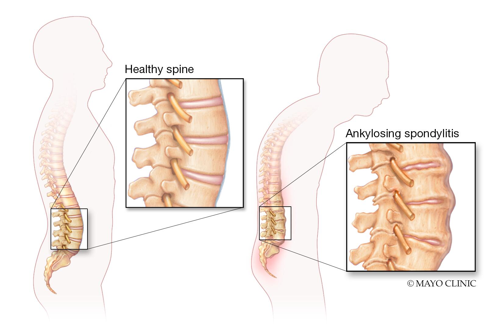 Spondylitis ankylosans: Symptome und Behandlung Spondylitis ankylosans: Symptome und Behandlung