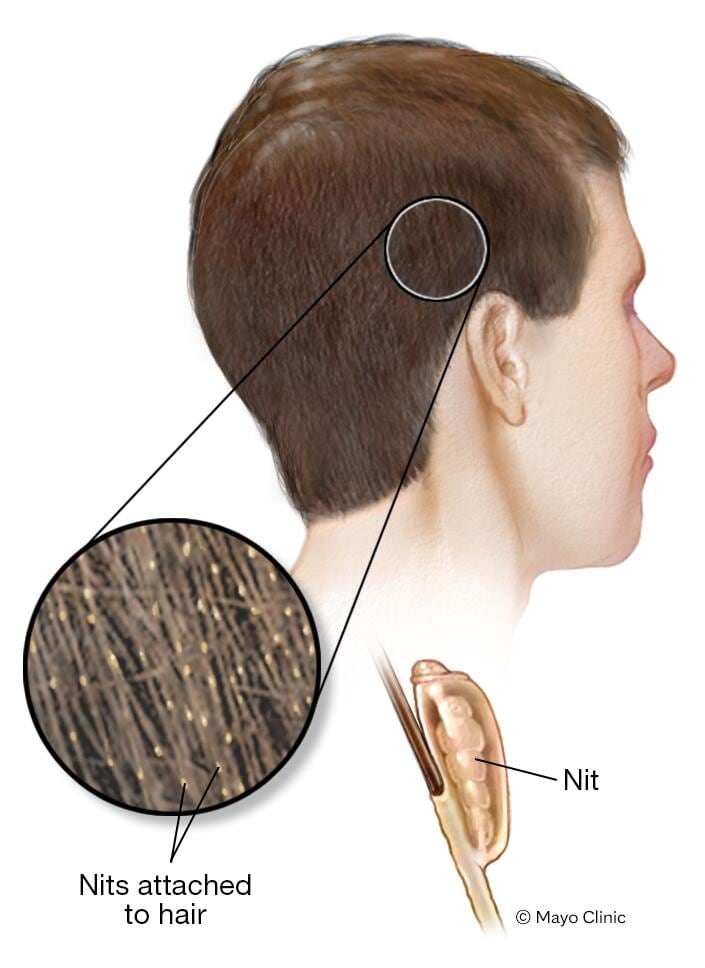 Head definition. Вши внутри кожи головы.