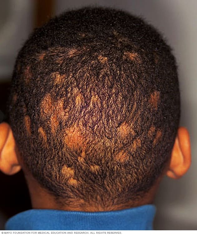 Itchy Scalp And Hair Loss: What Is The Relation Between Them? – SkinKraft