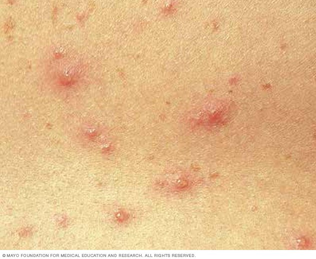 Chickenpox Disease Reference Guide