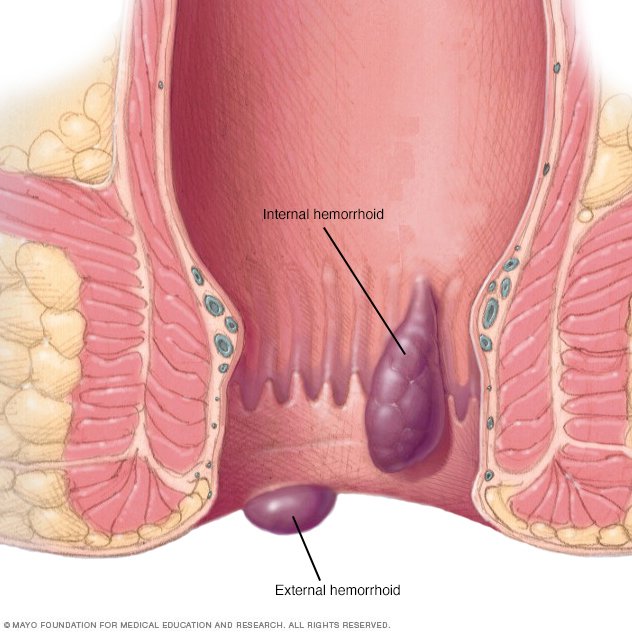 Anal Hemoroids 17