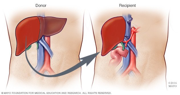 Wilson's disease Disease Reference Guide - Drugs.com