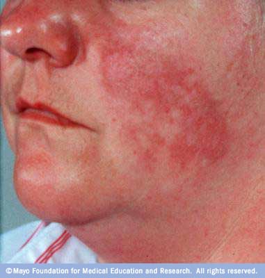 rash chest Facial pain and