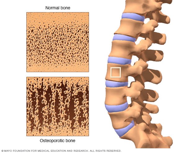 Once yearly shot osteoporosis