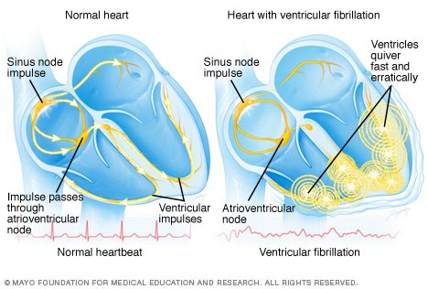 Ventricular fibrillation Disease Reference Guide - Drugs.com
