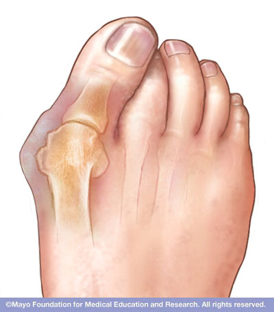Bunions Disease Reference Guide - Drugs.com