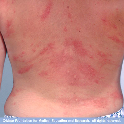 Toddler Skin Rash Pictures and Free Brochures