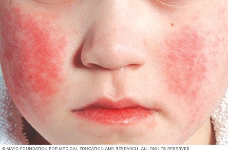 Red Circular Rash On Face - Doctor answers on HealthTap