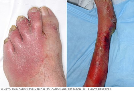 Health: Why cellulitis is a serious health risk | Daily ...