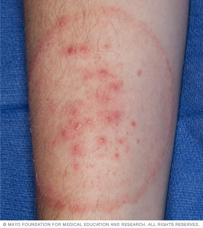 Ringworm Causes - MedicineNet