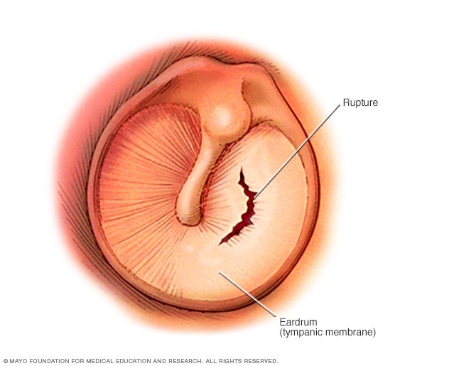 Ruptured Eardrum Perforated Eardrum Disease Reference