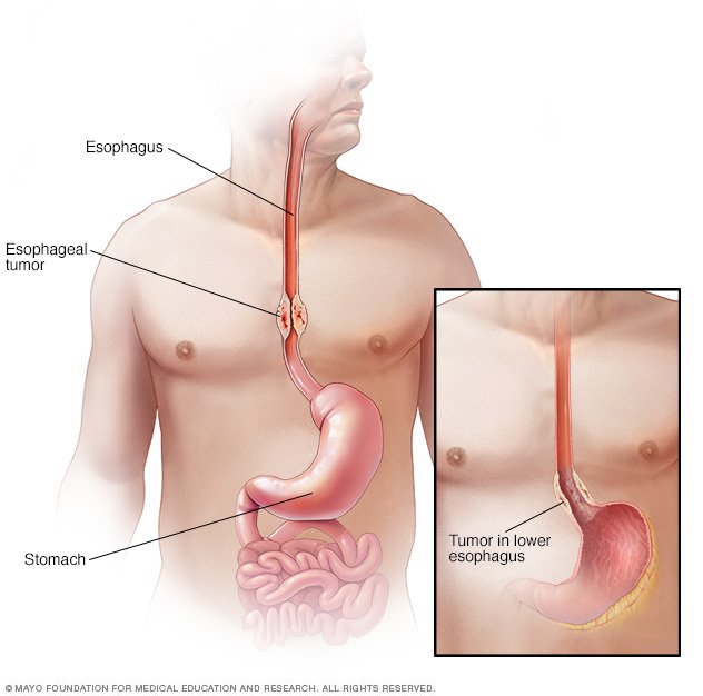 book peritoneal adhesions