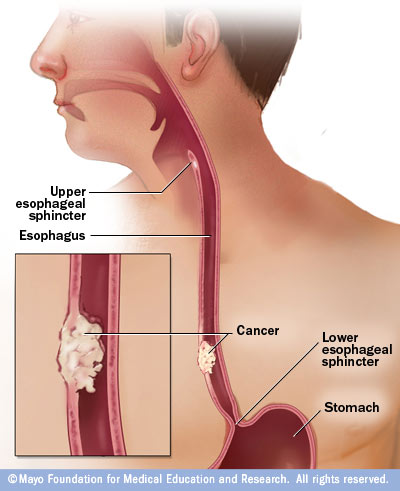 What is the best treatment for Barrett's esophagus?