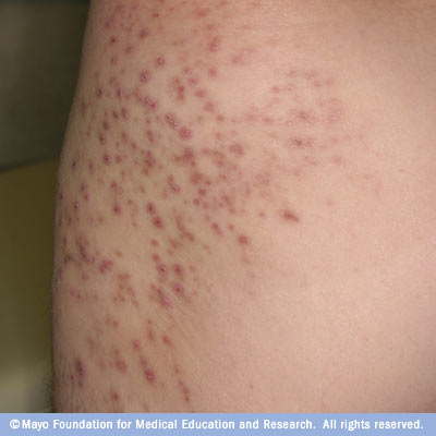 Folliculitis Symptoms - Mayo Clinic