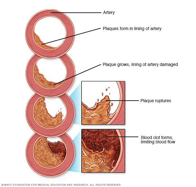 signs of intermittent claudication