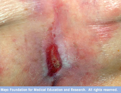 bedsores (pressure sores) disease reference guide - drugs bedsores (pressure sores) disease reference guide - drugs