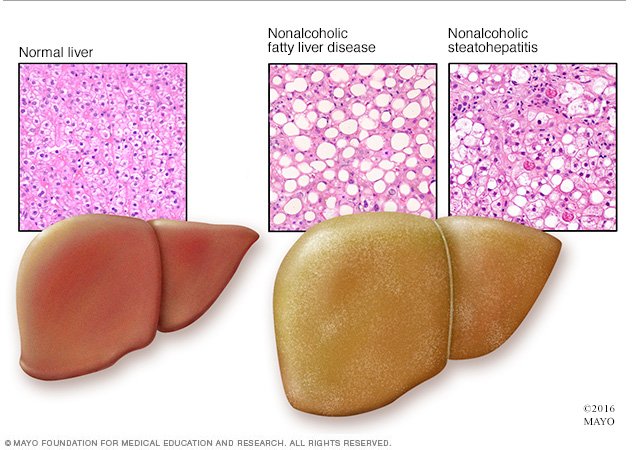 Fat Infiltration Of Liver 33