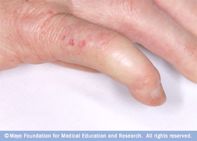 Red Itchy Bumps On Back Of Hands - Doctor ... - HealthTap